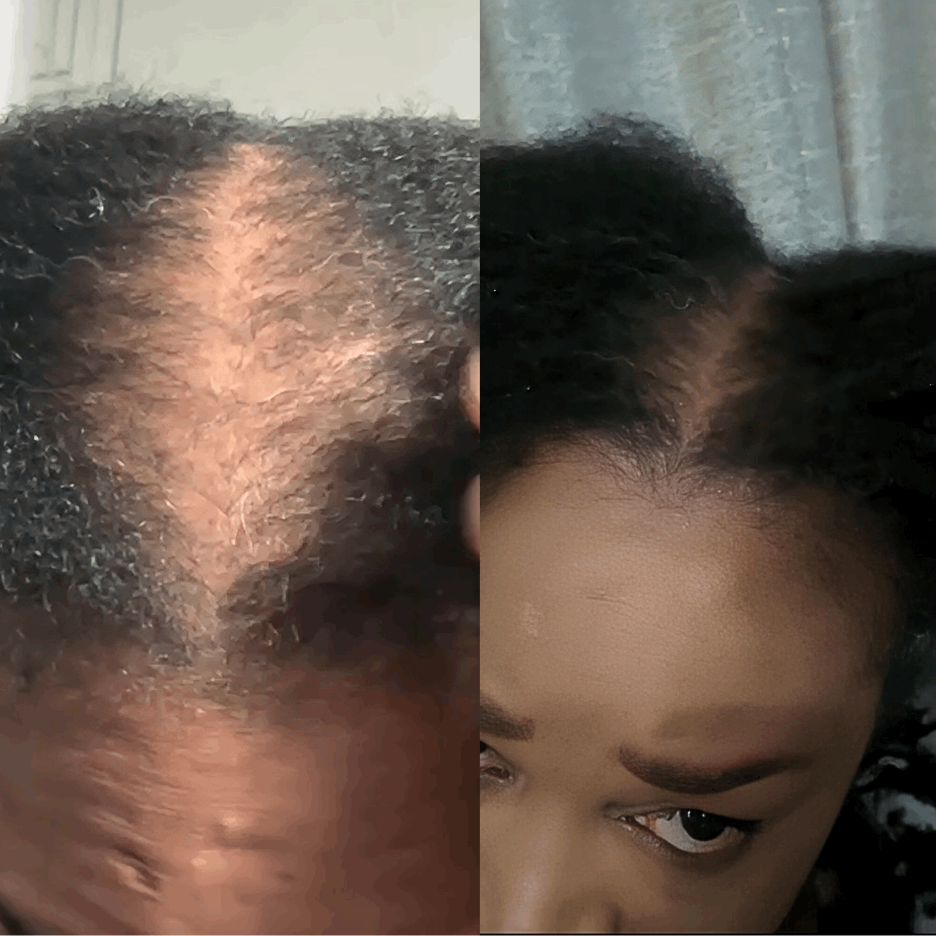 herbal hair growth oil to regrow thinning edges and bald spots