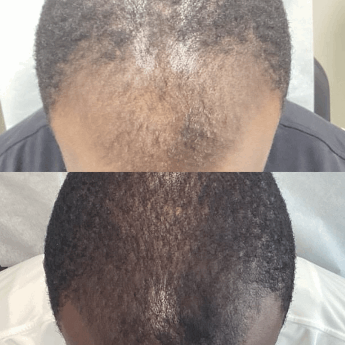 herbal hair growth oil to regrow thinning edges and bald spots
applying hair growth oil to scalp for natural regrowth
beard growth oil for patchy beard lightweight non-greasy