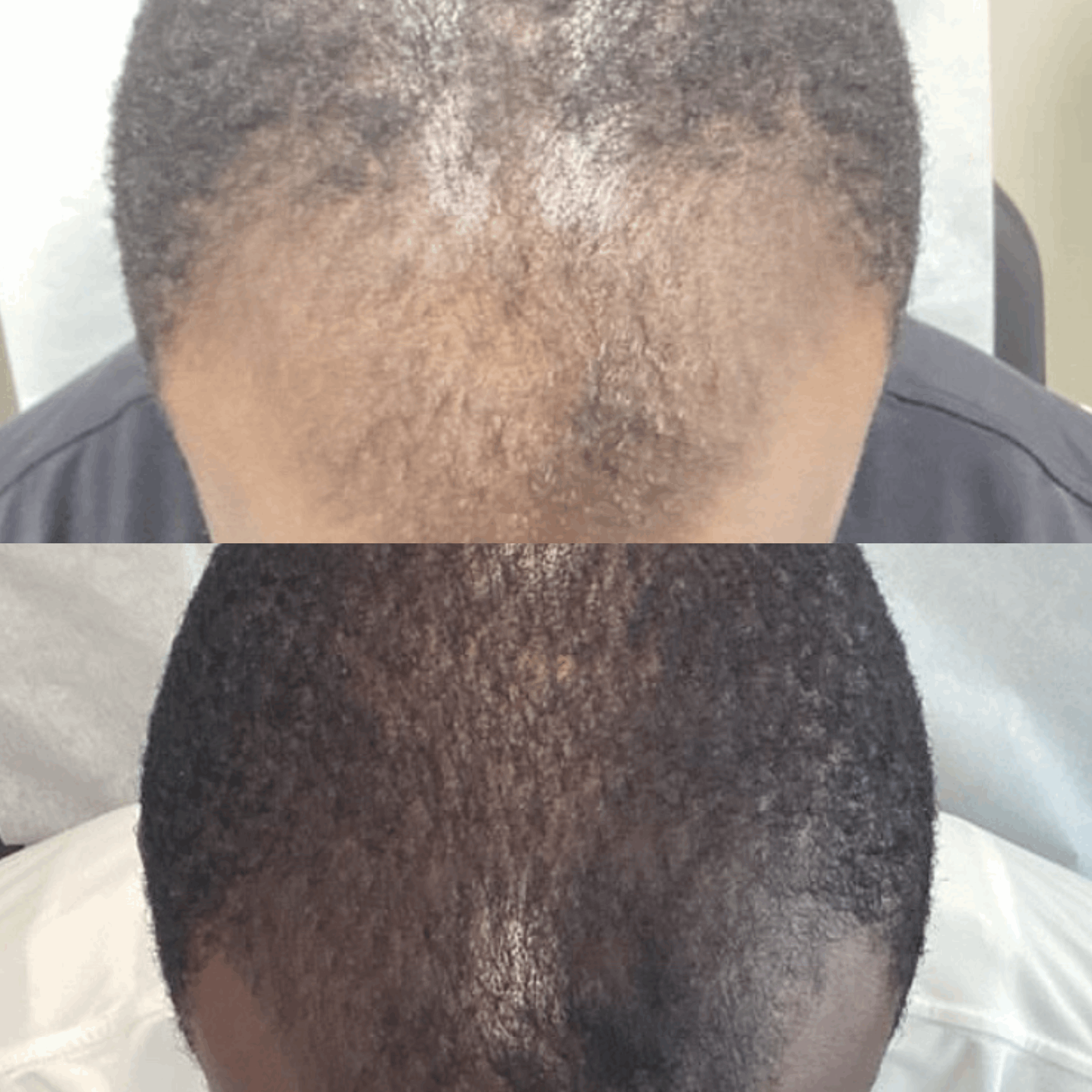 herbal hair growth oil to regrow thinning edges and bald spots
applying hair growth oil to scalp for natural regrowth
beard growth oil for patchy beard lightweight non-greasy