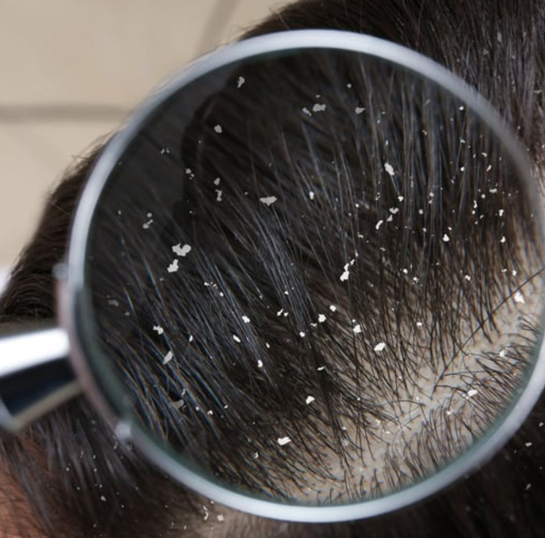 Natural Remedies for Common Hair Problems: Dandruff, Hair Loss, and More - TOKS NATURAL