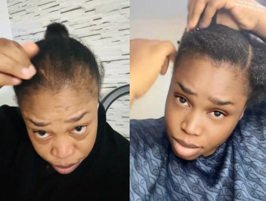 Woman sharing journey overcoming hair loss with natural products