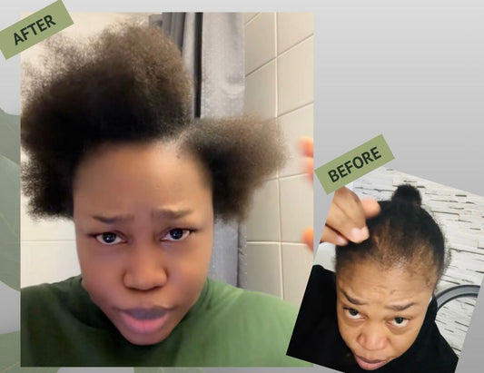 Before and after hair transformation showing natural hair regrowth with Ayurvedic remedies