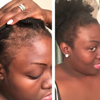 Before and after comparison of a woman's hair, showing scalp texture and hair density.